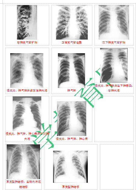 快收藏！臨床助理醫(yī)師實(shí)踐技能62個(gè)胸片（圖片診斷）