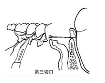 翻瓣術(shù)