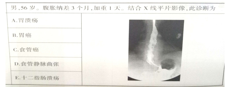 食管靜脈曲張