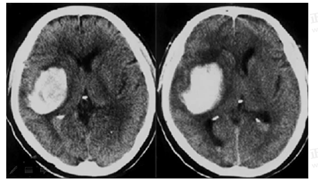 男55歲，左側(cè)肢體偏癱4小時(shí)，有高血壓史，診斷為