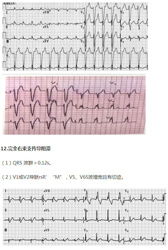 完全右束支傳導阻滯